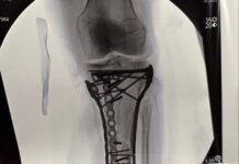 La impresionante imagen que compartió Lindsey Vonn tras una nueva operación por su fractura en los Juegos Olímpicos: “He tenido algunas dificultades”